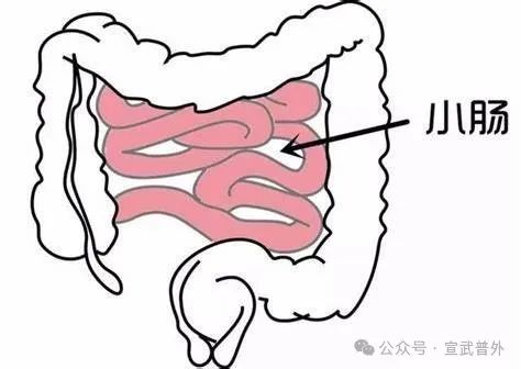 肠梗阻要做手术吗? 肠梗阻要做手术吗?