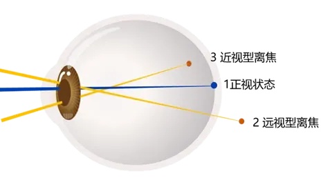 控制近视的周边离焦框架眼镜和角膜塑形镜，家长们，你们了解吗？