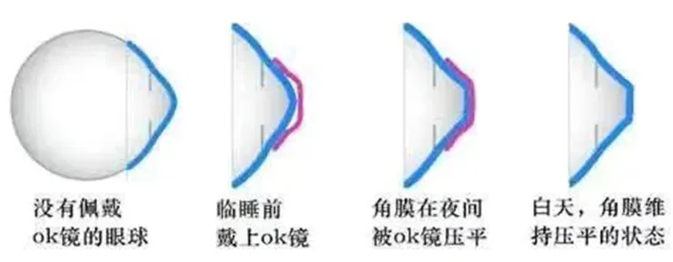 控制近视的周边离焦框架眼镜和角膜塑形镜，家长们，你们了解吗？