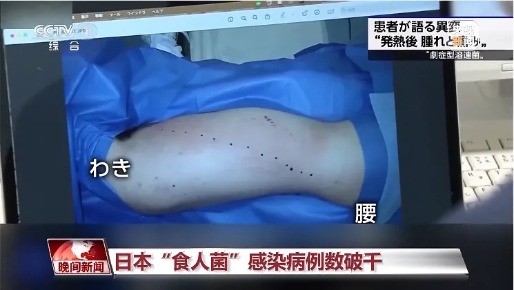 致死率超过30%!日本“食人菌”感染破千,有风险传入国内…… 致死率超过30%!日本“食人菌”感染破千,有风险传入国内……