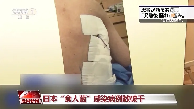 致死率超过30%!日本“食人菌”感染破千,有风险传入国内…… 致死率超过30%!日本“食人菌”感染破千,有风险传入国内……