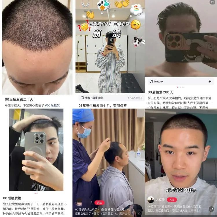第一批00后已开始植发！男性容貌焦虑为什么越来越严重