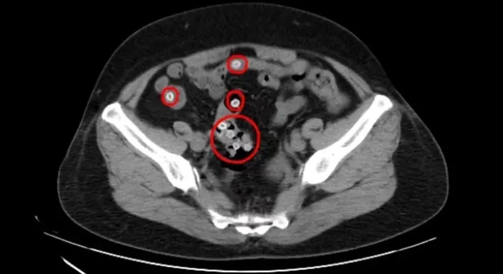 女子吃杨梅吃进医院!?吃杨梅要注意这些→ 女子吃杨梅吃进医院!?吃杨梅要注意这些→