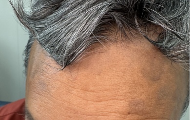 突发怪病？老伯身上出现“蓝色斑块”，原来是爱美惹的祸...