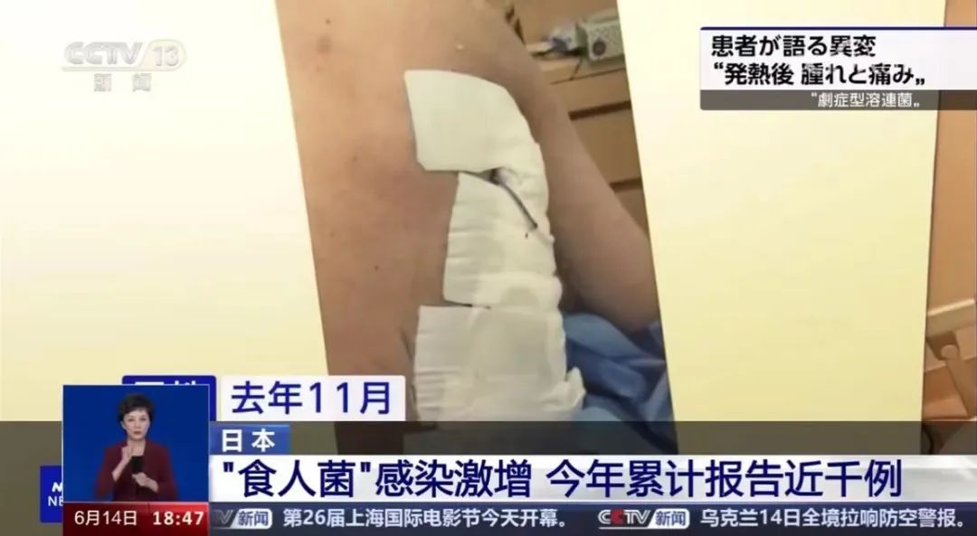 有传入国内风险！感染后48小时可致命！症状与感冒类似→