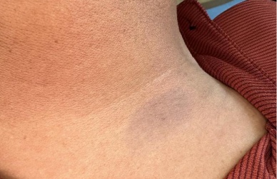 突发怪病？老伯身上出现“蓝色斑块”，原来是爱美惹的祸...