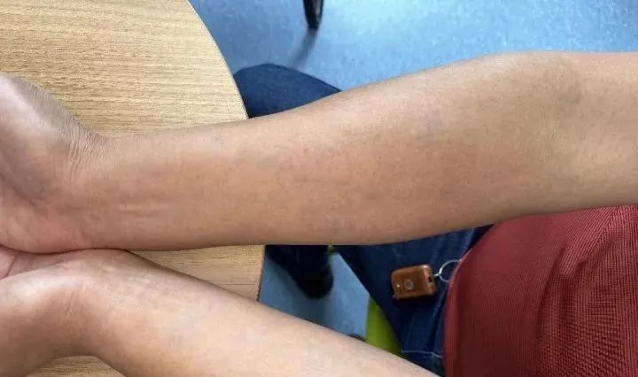 突发怪病？男子身上出现“蓝色斑块”，真相让人意外