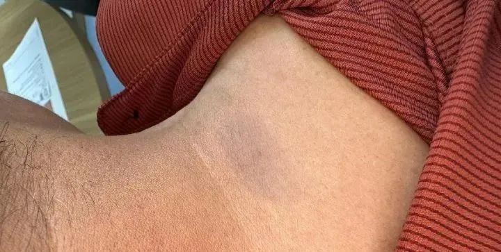 突发怪病？男子身上出现“蓝色斑块”，真相让人意外