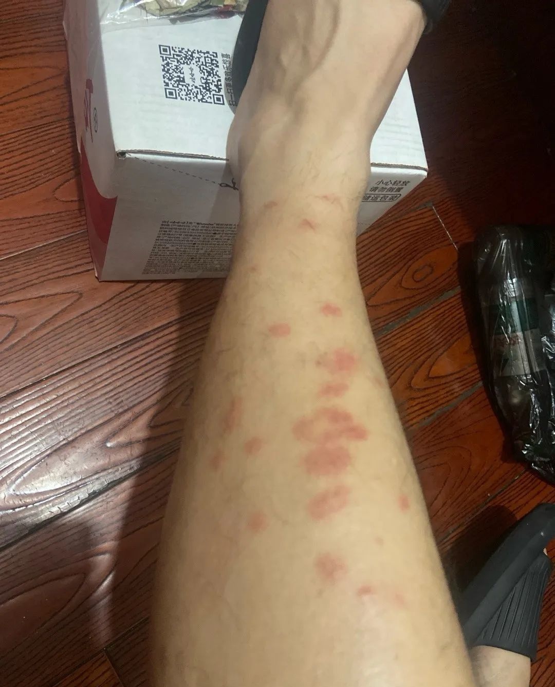 密密麻麻，奇痒无比！不少人“中招”后直呼：毫无防备，不敢了