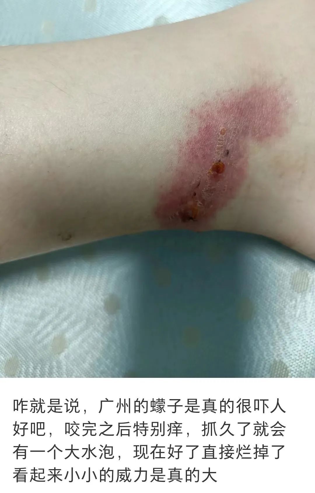 崩溃!近期猛增,比高温更难熬,不少广东人中招 崩溃!近期猛增,比高温更难熬,不少广东人中招