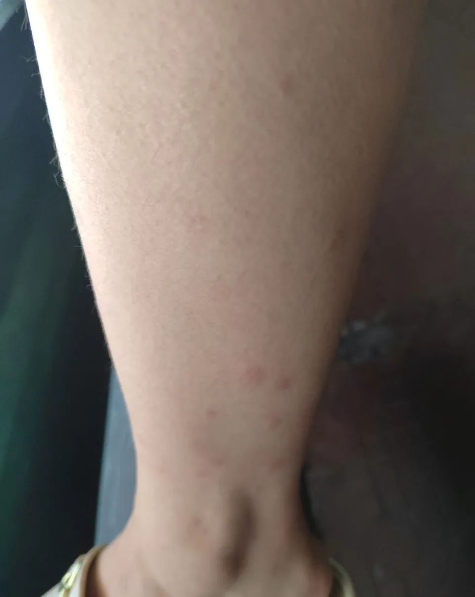 密密麻麻，奇痒无比！不少人“中招”后直呼：毫无防备，不敢了