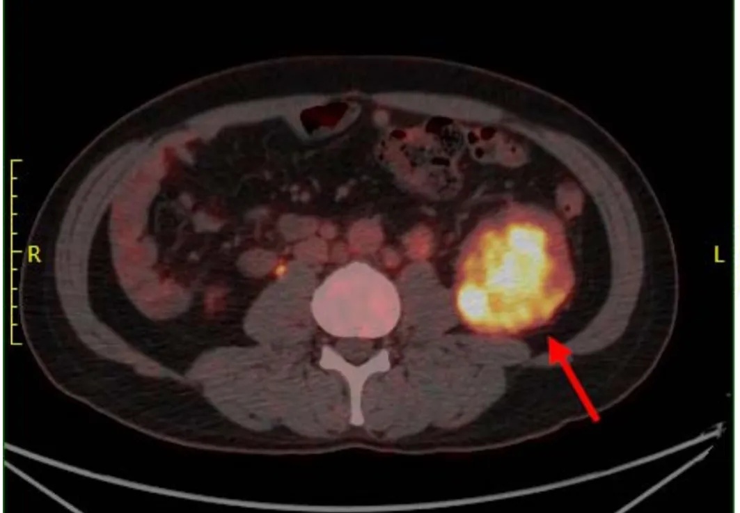 突然确诊癌症,已多处转移!男子悔不当初:膝盖疼了一个月 突然确诊癌症,已多处转移!男子悔不当初:膝盖疼了一个月
