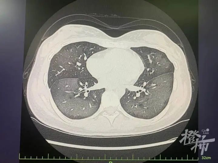 才1小时!20岁姑娘肺白了!杭州医生紧急提醒:最近这件事,很多人错了 才1小时!20岁姑娘肺白了!杭州医生紧急提醒:最近这件事,很多人错了