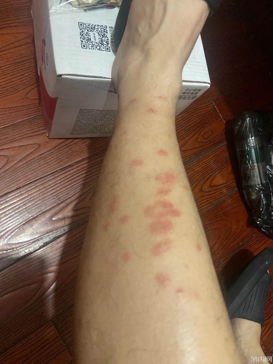 去年被咬的疤还在,今年又被咬!比蚊子还毒的“吸血鬼”又来了,痒到挠出血…… 去年被咬的疤还在,今年又被咬!比蚊子还毒的“吸血鬼”又来了,痒到挠出血……