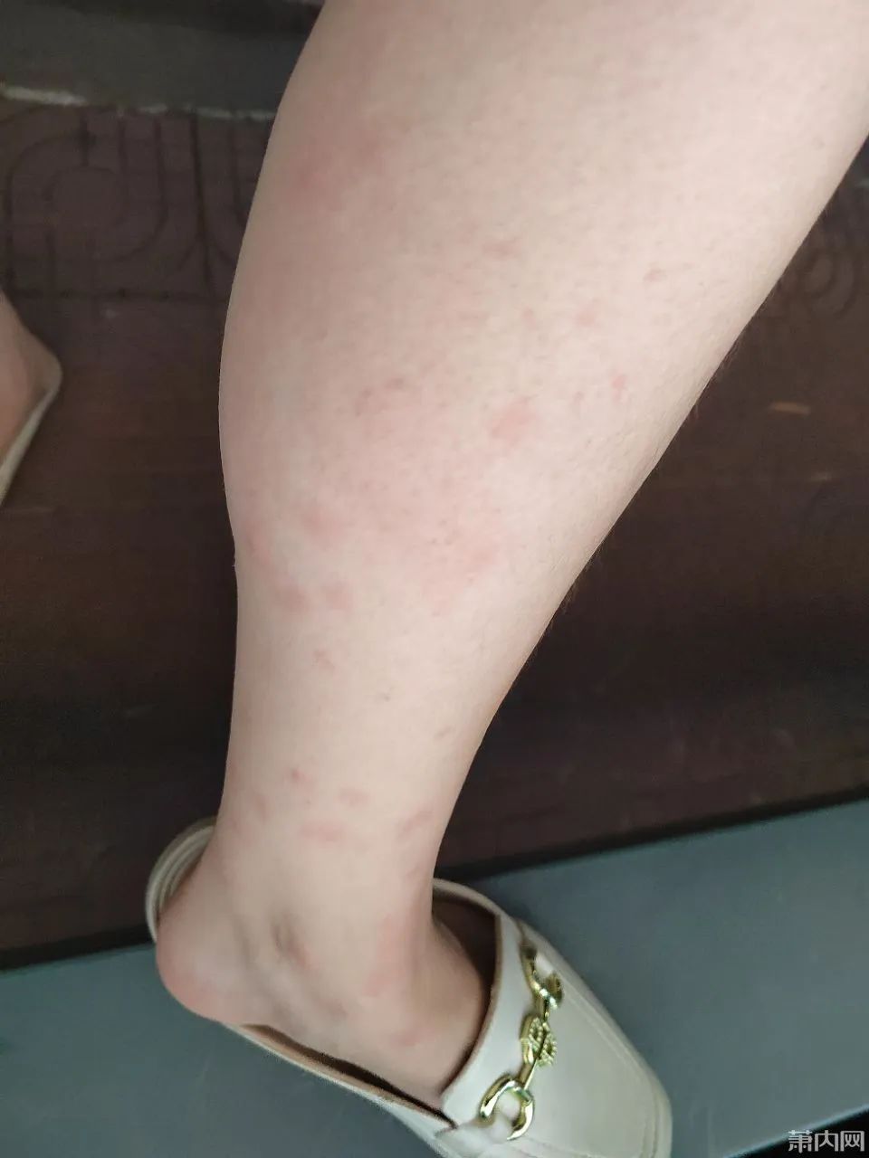 去年被咬的疤还在,今年又被咬!比蚊子还毒的“吸血鬼”又来了,痒到挠出血…… 去年被咬的疤还在,今年又被咬!比蚊子还毒的“吸血鬼”又来了,痒到挠出血……