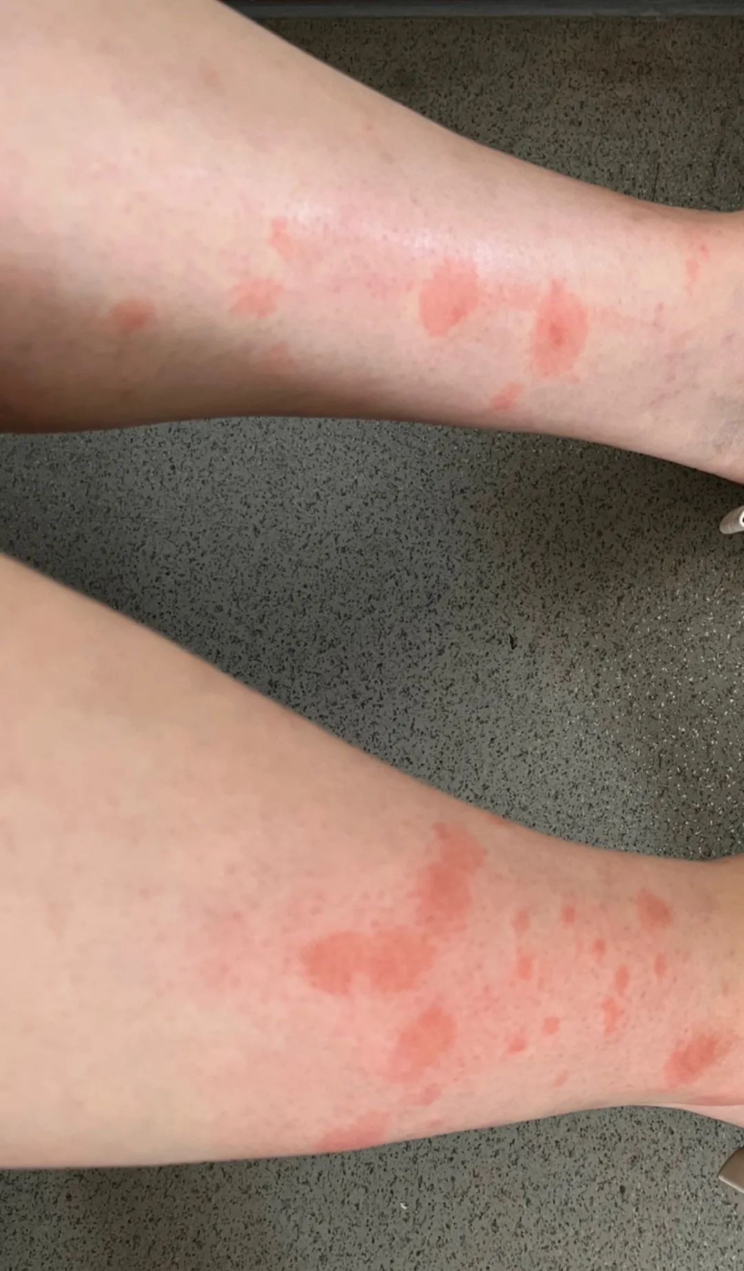 去年被咬的疤还在,今年又被咬!比蚊子还毒的“吸血鬼”又来了,痒到挠出血…… 去年被咬的疤还在,今年又被咬!比蚊子还毒的“吸血鬼”又来了,痒到挠出血……