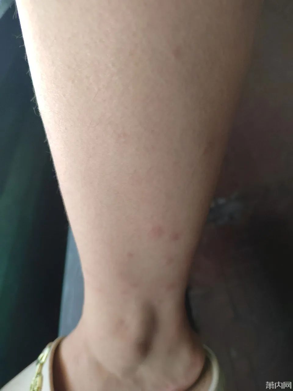 去年被咬的疤还在,今年又被咬!比蚊子还毒的“吸血鬼”又来了,痒到挠出血…… 去年被咬的疤还在,今年又被咬!比蚊子还毒的“吸血鬼”又来了,痒到挠出血……