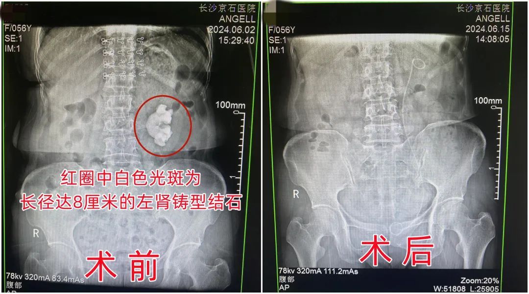 55岁女子下腹部不适，就医查出“玫瑰花状”肾结石