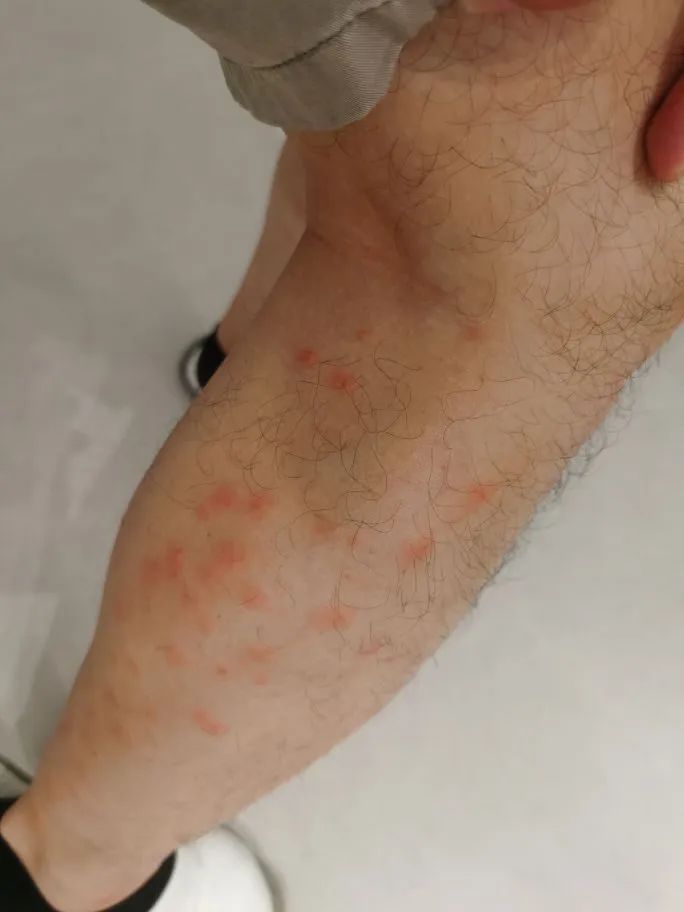 去年被咬的疤还在,今年又被咬!比蚊子还毒的“吸血鬼”又来了,痒到挠出血…… 去年被咬的疤还在,今年又被咬!比蚊子还毒的“吸血鬼”又来了,痒到挠出血……