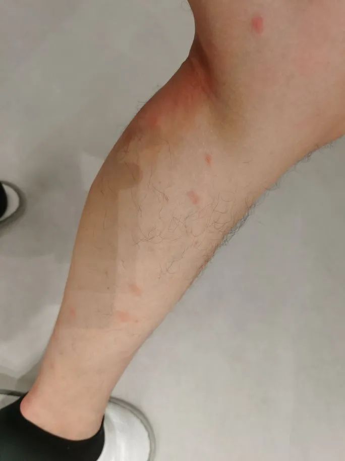 去年被咬的疤还在,今年又被咬!比蚊子还毒的“吸血鬼”又来了,痒到挠出血…… 去年被咬的疤还在,今年又被咬!比蚊子还毒的“吸血鬼”又来了,痒到挠出血……