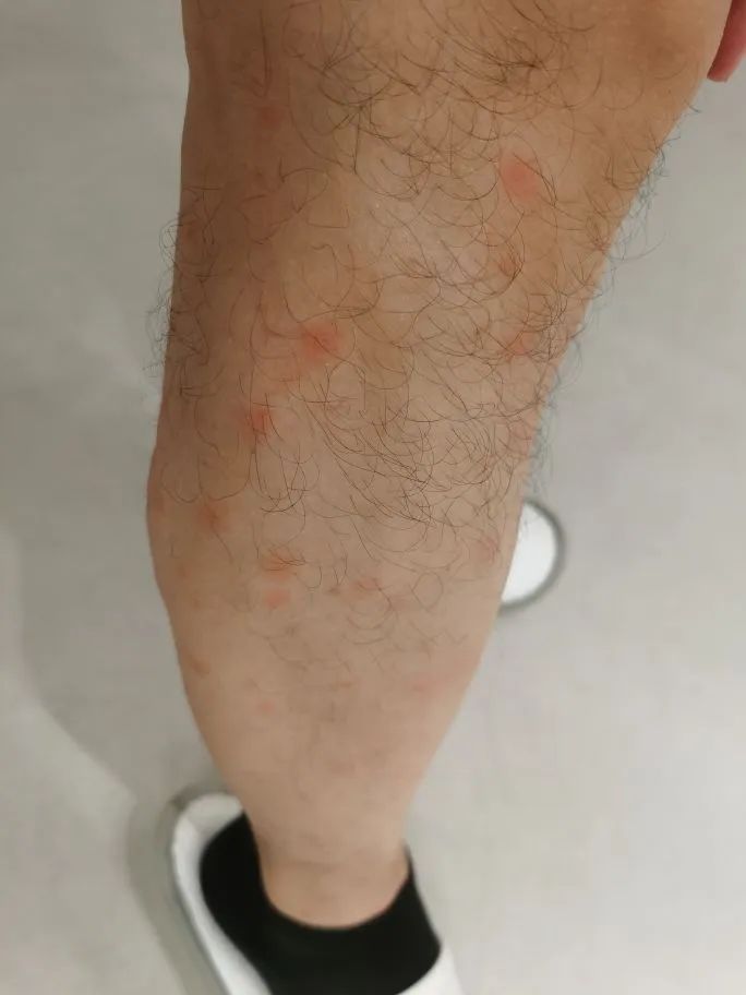 去年被咬的疤还在,今年又被咬!比蚊子还毒的“吸血鬼”又来了,痒到挠出血…… 去年被咬的疤还在,今年又被咬!比蚊子还毒的“吸血鬼”又来了,痒到挠出血……