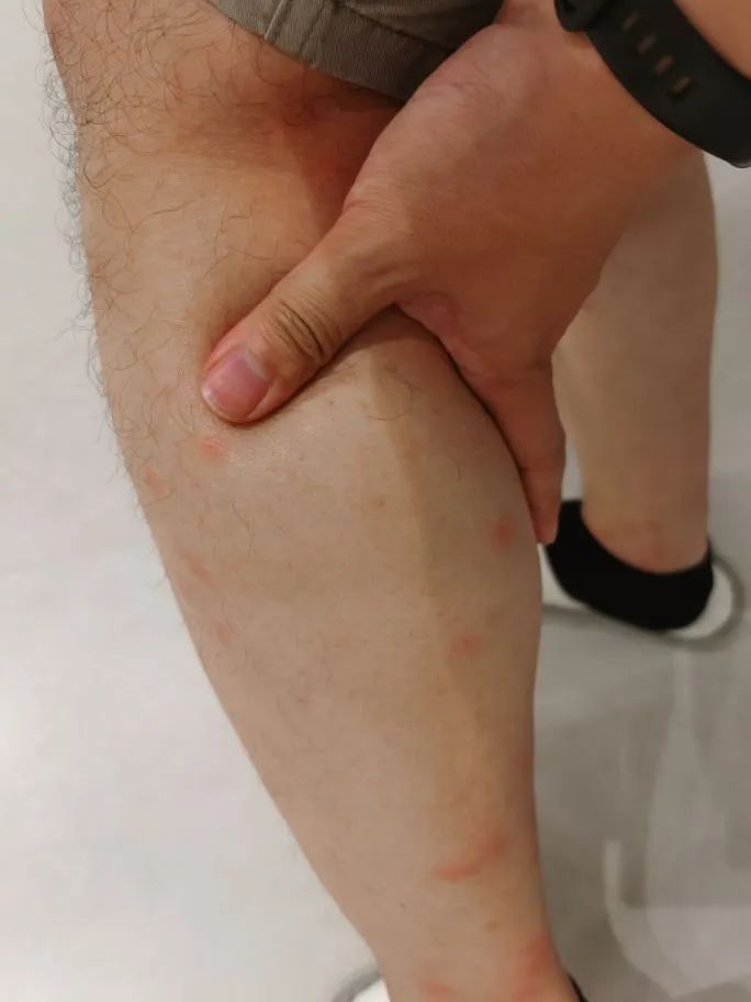 去年被咬的疤还在,今年又被咬!比蚊子还毒的“吸血鬼”又来了,痒到挠出血…… 去年被咬的疤还在,今年又被咬!比蚊子还毒的“吸血鬼”又来了,痒到挠出血……