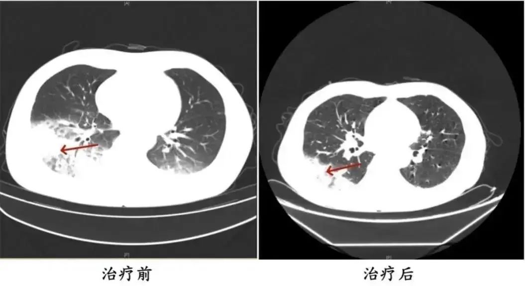 “军团菌”藏身空调,多人中招!紧急提醒→ “军团菌”藏身空调,多人中招!紧急提醒→
