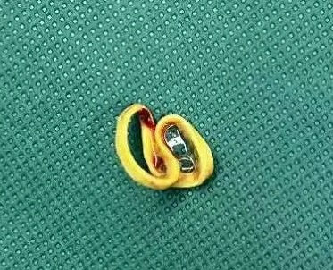 鼻子里竟有“橡皮筋”！深圳4岁娃长期鼻塞流涕……