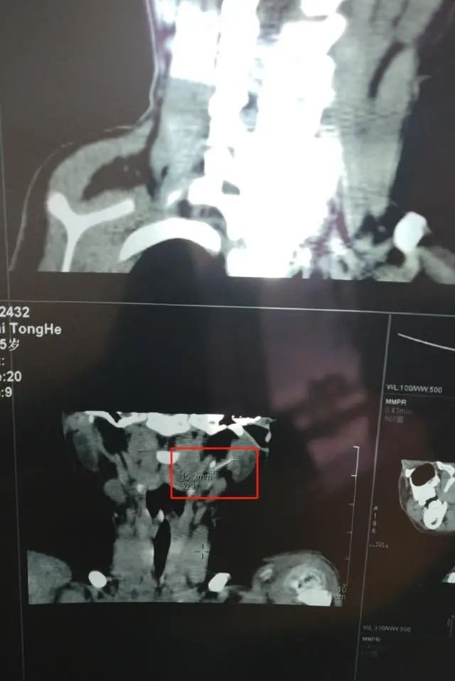 男婴输液针头留在体内5年，最新消息：已取出