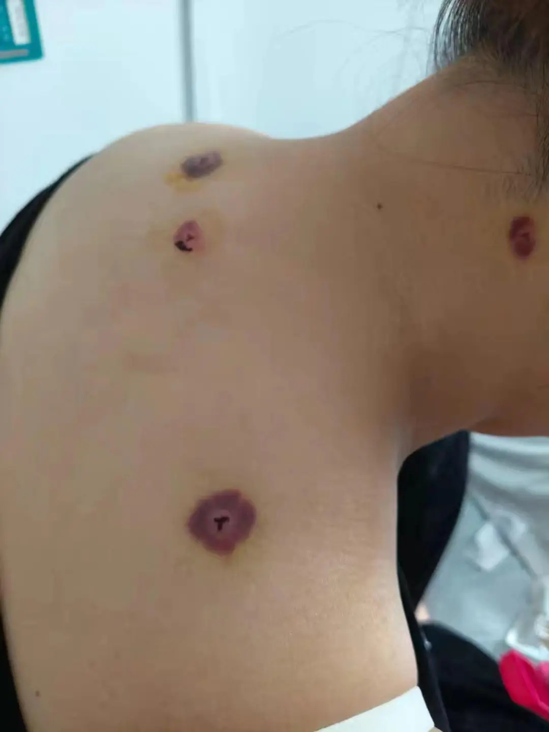"疑似全身细菌感染！"女子称用"蚂蟥吸血"治颈椎病，突发休克