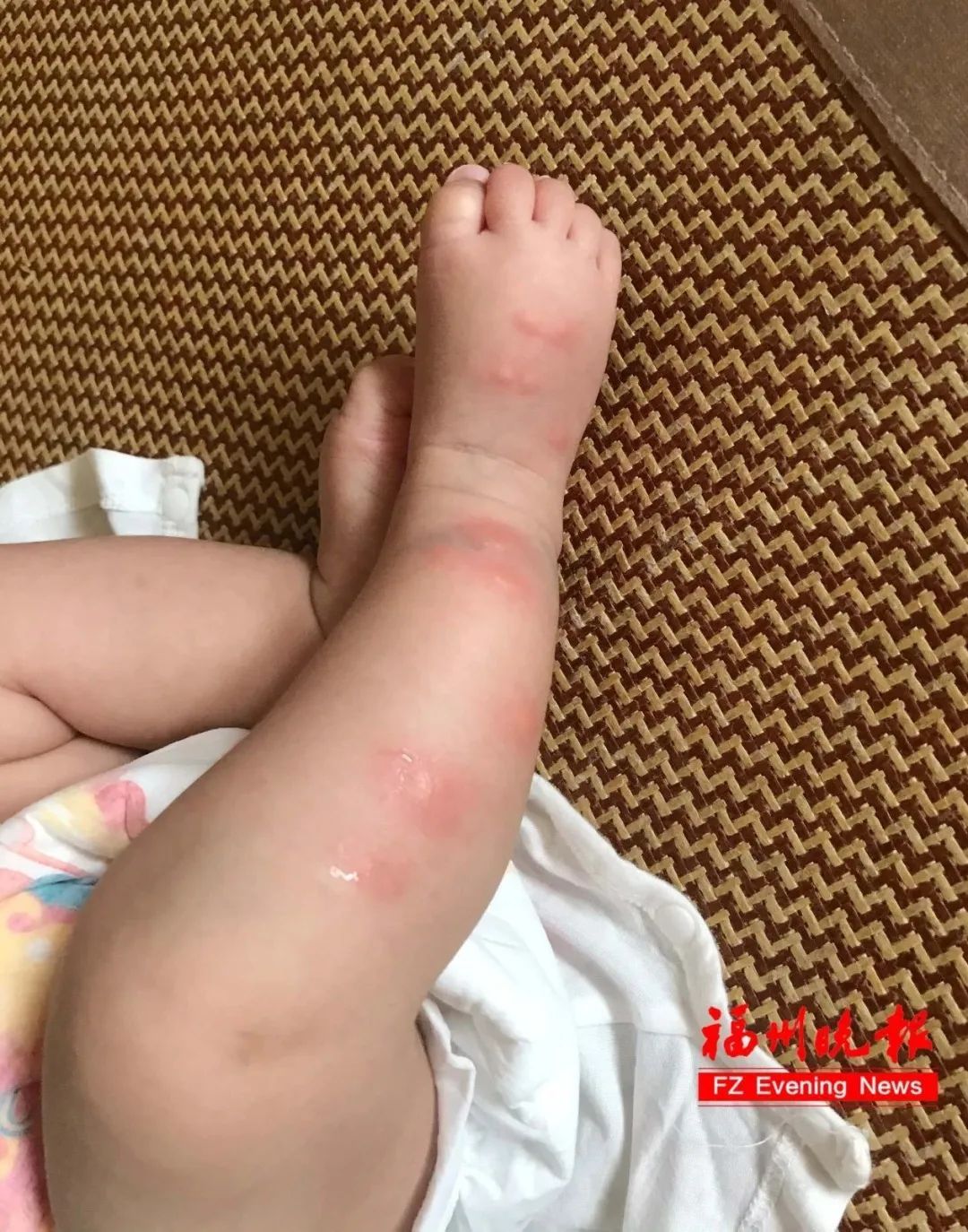 近期多发！不少人中招！福州吴女士：痒到崩溃！