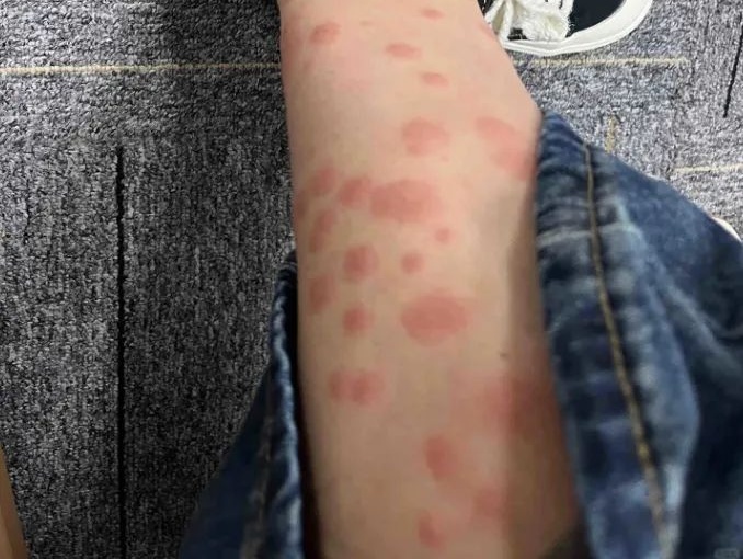 被咬后奇痒无比,长时间难以消退!多人中招 被咬后奇痒无比,长时间难以消退!多人中招