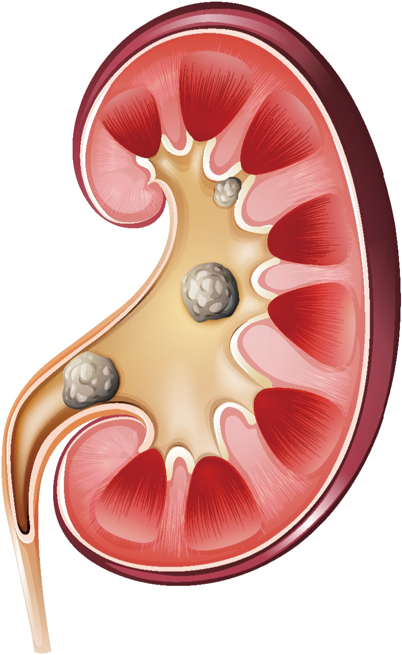 生活方式不佳？小心肾结石找上你