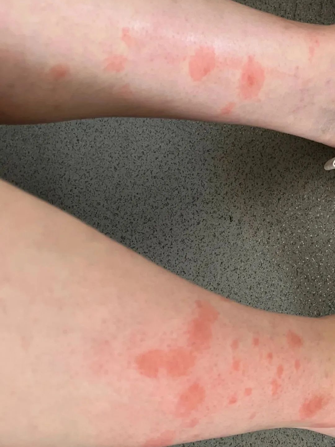 被咬后奇痒无比,长时间难以消退!多人中招 被咬后奇痒无比,长时间难以消退!多人中招