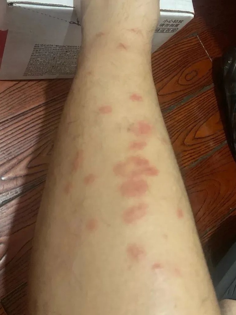 被咬后奇痒无比,长时间难以消退!多人中招 被咬后奇痒无比,长时间难以消退!多人中招