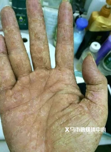 小心感染!出现这些症状,赶紧去医院 小心感染!出现这些症状,赶紧去医院