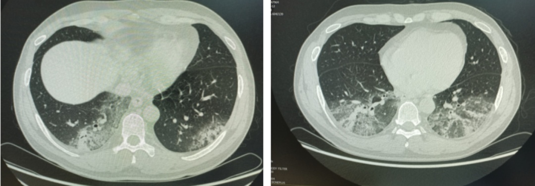 夏季高发！大家都在用的它可致肺部严重感染，专家提醒