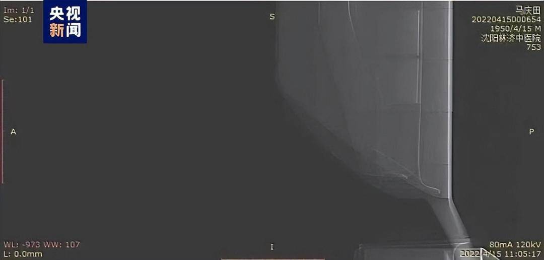 伪造检查报告、虚构检验项目 辽宁两家医院涉嫌欺诈骗保