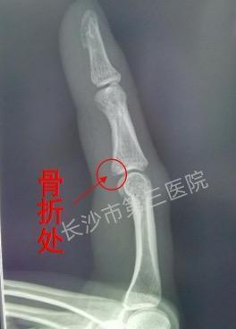 女子打蚊子把手“打”骨折！医生都难以置信，原因竟是……