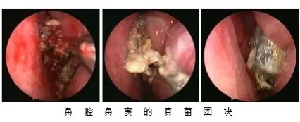 不是感冒！浙江女子头晕鼻塞不好，医生在鼻子里发现了一整团霉菌！