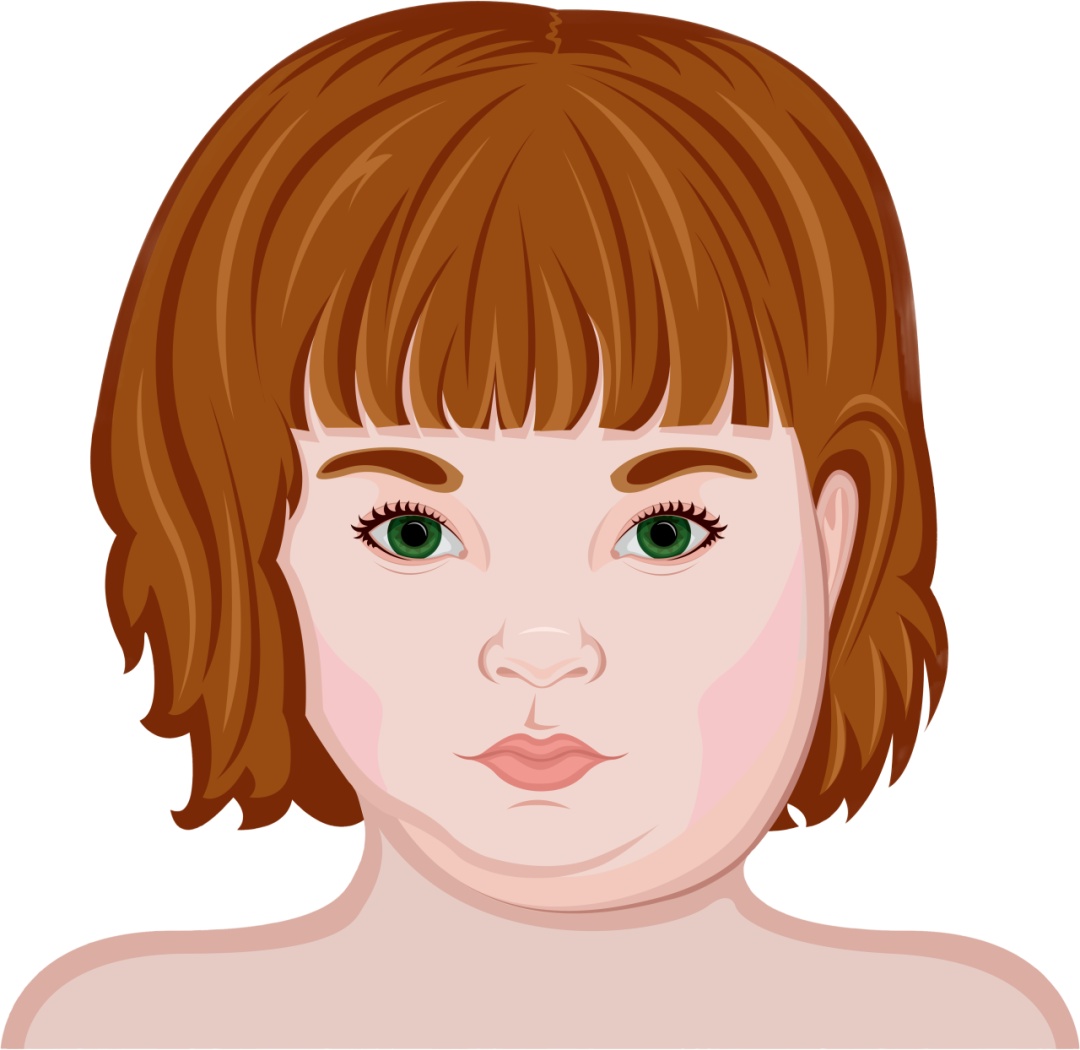 儿童流行性腮腺炎高发期,预防重于治疗 儿童流行性腮腺炎高发期,预防重于治疗