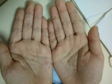 一人得病，可能全家“痒到怀疑人生”