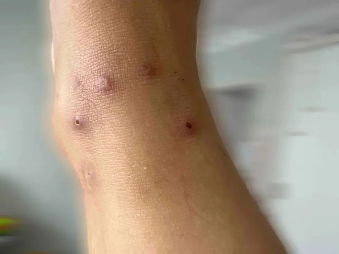 别拿蚂蚁不当虫子,被咬一次就“要命”! 别拿蚂蚁不当虫子,被咬一次就“要命”!