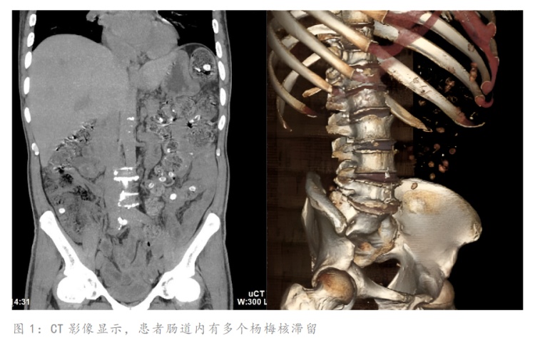 杨梅核咽下肚子能清肠解毒?两名老人因此腹痛难忍进了医院 杨梅核咽下肚子能清肠解毒?两名老人因此腹痛难忍进了医院