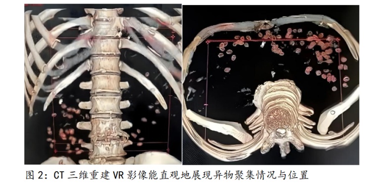 杨梅核咽下肚子能清肠解毒?两名老人因此腹痛难忍进了医院 杨梅核咽下肚子能清肠解毒?两名老人因此腹痛难忍进了医院