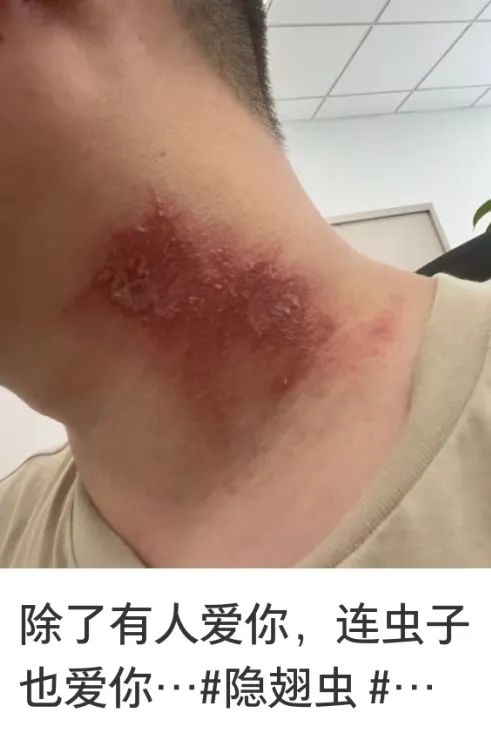 它又来了?男子莫名中招!受害者一堆,很多没见到“元凶” 它又来了?男子莫名中招!受害者一堆,很多没见到“元凶”
