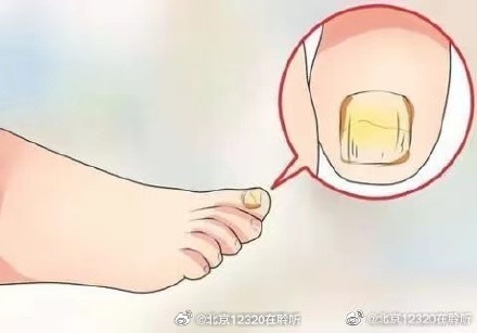 日常如何预防灰指甲？