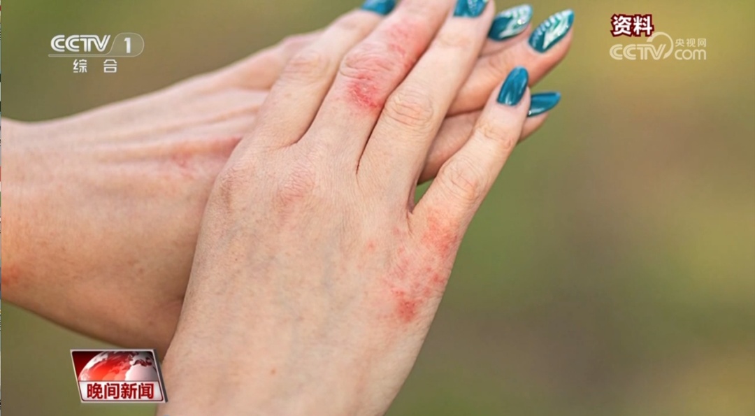 皮肤红肿、瘙痒？你可能“对太阳过敏”！防护指南快查收→