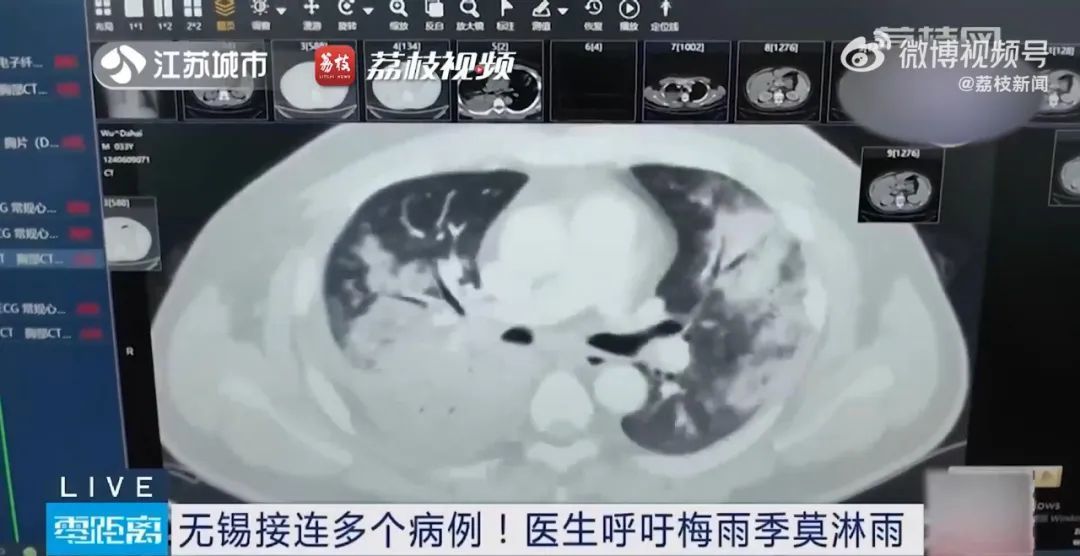 不要淋雨！已经有人"白肺"