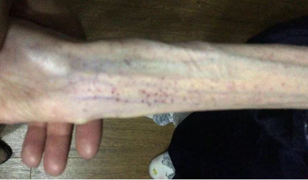 太吓人!女子1米6体重50斤仍在减肥:个人喜欢,不影响生活 太吓人!女子1米6体重50斤仍在减肥:个人喜欢,不影响生活